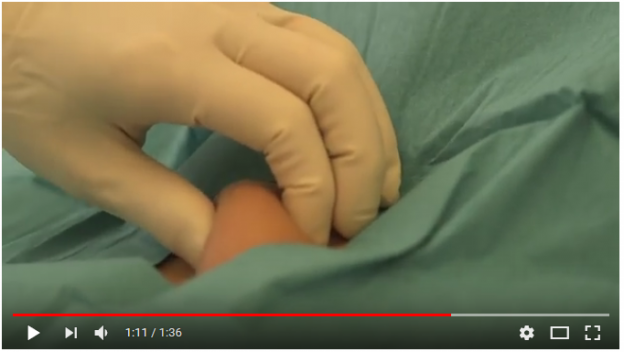 Video: Scenesse Implantat wird einer der ersten niederländischen Patientinnen injiziert